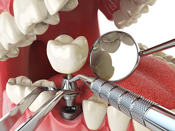 Best Emergency Root Canal Treatment in Centerville, IA